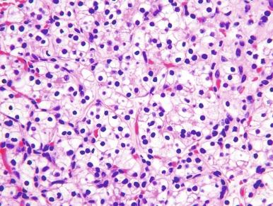 Fig. 2.1, Renal cell carcinoma, ISUP grade 1.