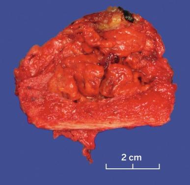 Fig. 2.11, Renal cell carcinoma metastatic to a rib.