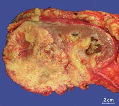 Fig. 2.13, Renal cell carcinoma.