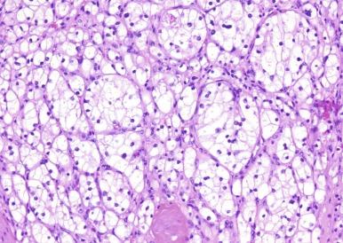 Fig. 2.14, Renal cell carcinoma.