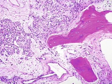 Fig. 2.15, Renal cell carcinoma.