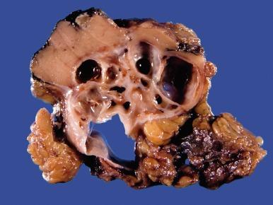 Fig. 2.16, Multilocular cystic renal neoplasm of low malignant potential.