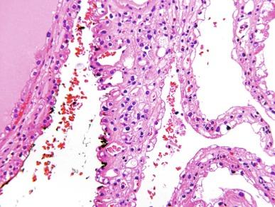 Fig. 2.18, Multilocular cystic renal neoplasm of low malignant potential.