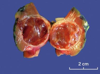 Fig. 2.19, Extensively cystic clear cell renal cell carcinoma.