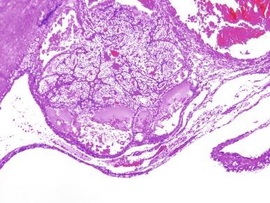 Fig. 2.20, Extensively cystic clear cell renal cell carcinoma (CCRCC).