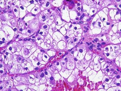 Fig. 2.2, Renal cell carcinoma, ISUP grade 2.