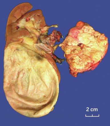 Fig. 2.23, Papillary renal cell carcinoma.