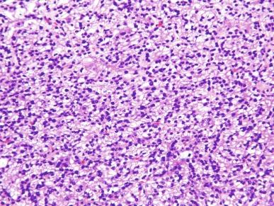 Fig. 2.27, Papillary renal cell carcinoma.