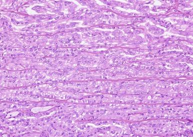 Fig. 2.28, Papillary renal cell carcinoma.