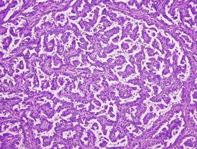 Fig. 2.30, Papillary renal cell carcinoma (PRCC).