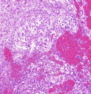 Fig. 2.3, Renal cell carcinoma, ISUP grade 3.