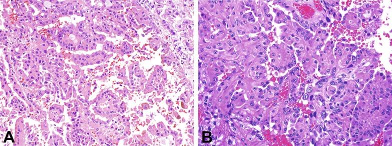 Fig. 2.31, Papillary renal cell carcinoma (A and B). In this type 2 tumor the papillae are thicker and are lined by cells with large irregular nuclei and abundant eosinophilic cytoplasm.