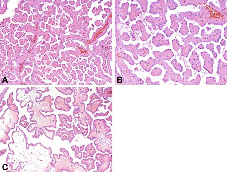 Fig. 2.33, Papillary renal cell carcinoma, oncocytic variant (A to C). Tumor cells have relatively abundant cytoplasm and round nonoverlapping nuclei that are arranged linearly toward the cell apices and bear inconspicuous nucleoli (A to C).