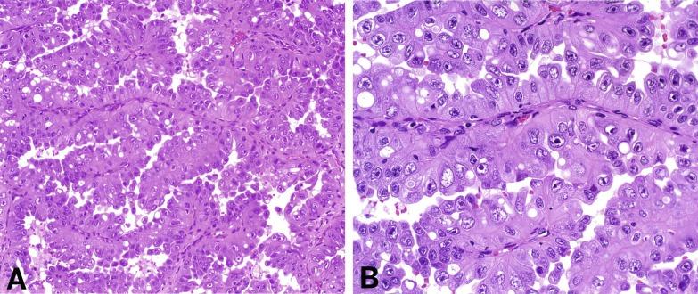 Fig. 2.35, Hereditary leiomyomatosis and renal cell cancer (HLRCC) syndrome