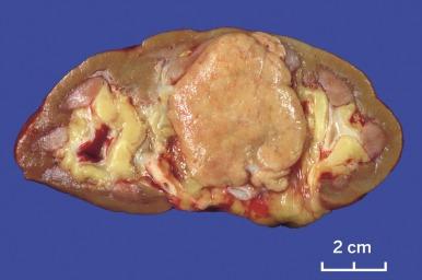 Fig. 2.36, Chromophobe renal cell carcinoma.