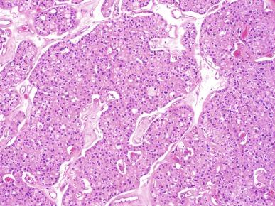 Fig. 2.38, Chromophobe renal cell carcinoma.