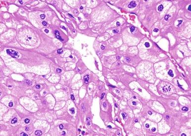 Fig. 2.39, Chromophobe renal cell carcinoma.