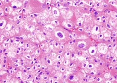 Fig. 2.40, Chromophobe renal cell carcinoma.