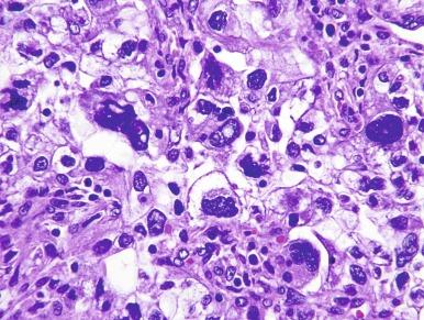 Fig. 2.4, Renal cell carcinoma, ISUP grade 4.