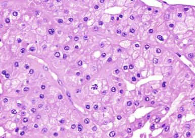 Fig. 2.41, Chromophobe renal cell carcinoma.