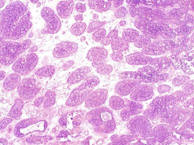 Fig. 2.43, Chromophobe renal cell carcinoma.