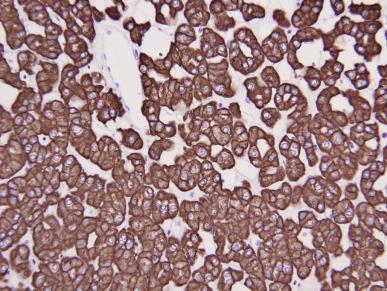 Fig. 2.44, Chromophobe renal cell carcinoma.