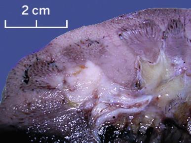 Fig. 2.48, Collecting duct carcinoma.