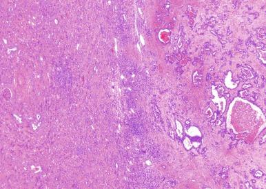 Fig. 2.49, Collecting duct carcinoma.