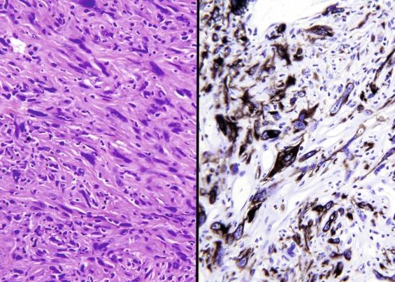 Fig. 2.5, Renal cell carcinoma, ISUP grade 4, sarcomatoid differentiation.