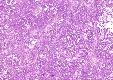 Fig. 2.51, Collecting duct carcinoma.