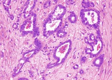 Fig. 2.52, Collecting duct carcinoma.