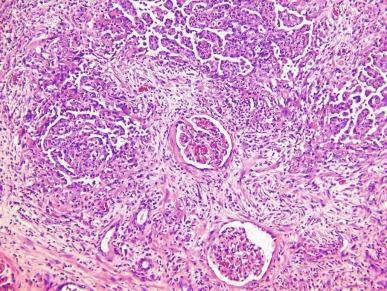 Fig. 2.55, Renal medullary carcinoma.