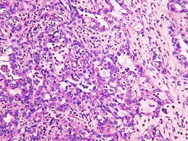 Fig. 2.56, Renal medullary carcinoma.