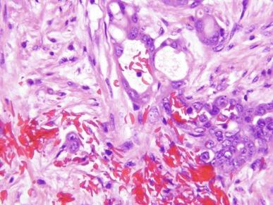 Fig. 2.57, Renal medullary carcinoma.