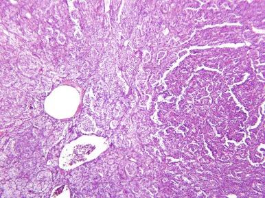 Fig. 2.60, Translocation carcinoma.