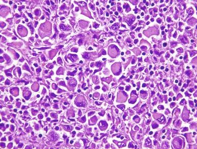 Fig. 2.6, Renal cell carcinoma, ISUP grade 4, rhabdoid differentiation.