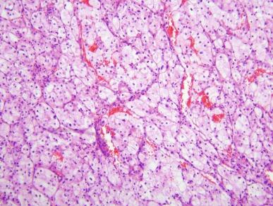 Fig. 2.61, Translocation carcinoma.