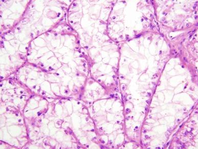 Fig. 2.63, Translocation carcinoma.