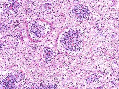 Fig. 2.66, The t(6:11) renal cell carcinoma: transcription factor EB gene ( TFEB ) rearranged renal cell carcinoma.