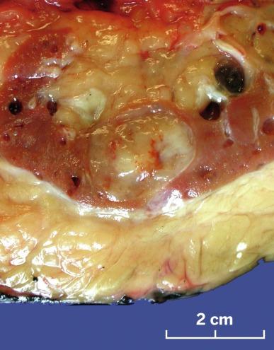 Fig. 2.69, Mucinous tubular and spindle cell carcinoma.