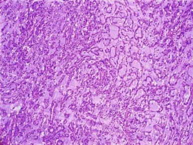 Fig. 2.70, Mucinous tubular and spindle cell carcinoma.