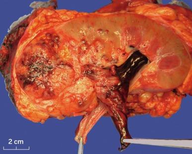 Fig. 2.7, Sarcomatoid clear cell carcinoma extending into renal collecting system. The tumor also had extended into renal vein and inferior vena cava.