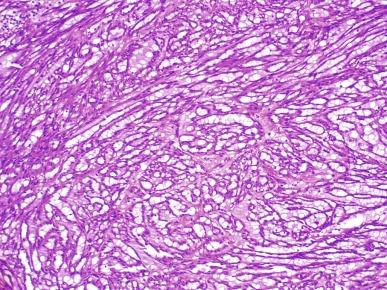 Fig. 2.71, Mucinous tubular and spindle cell carcinoma.