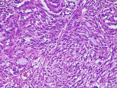 Fig. 2.72, Mucinous tubular and spindle cell carcinoma.