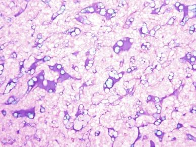 Fig. 2.73, Mucinous tubular and spindle cell carcinoma.