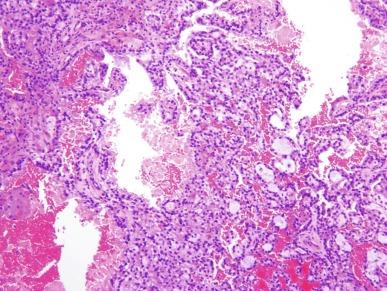 Fig. 2.74, Mucinous tubular and spindle cell carcinoma.