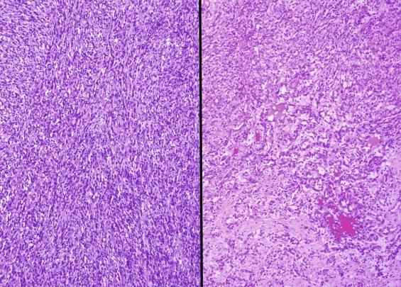 Fig. 2.78, Spindle cell–predominant mucinous tubular and spindle cell carcinoma.