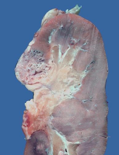 Fig. 2.80, Tubulocystic carcinoma.