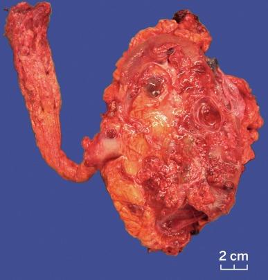 Fig. 2.8, Renal cell carcinoma extending into renal vein and vena cava.