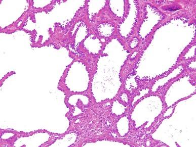 Fig. 2.82, Tubulocystic carcinoma.